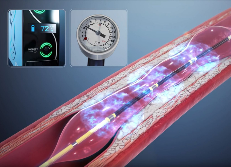Shockwave Intravascular Lithotripsy Valley Health System